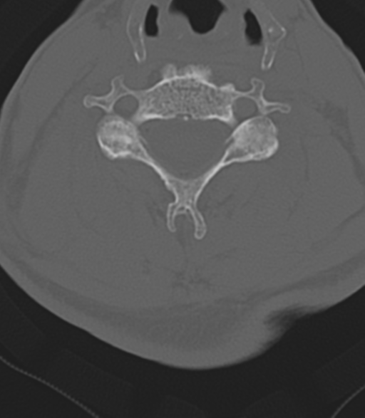 File:Cervical spine fractures with vertebral artery dissection (Radiopaedia 53296-59268 Axial bone window 33).png