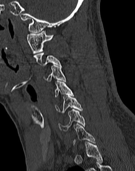 Cervical spondylodiscitis (Radiopaedia 28057-29489 Sagittal bone window 23).jpg