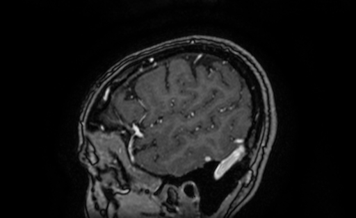 Cervical spondylodiscitis and calvarial hemangioma (Radiopaedia 64317-73103 Sagittal T1 C+ 64).jpg