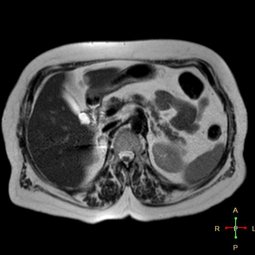 File:Cervical stump squamous cell carcinoma (Radiopaedia 48049-52858 I 7).jpg