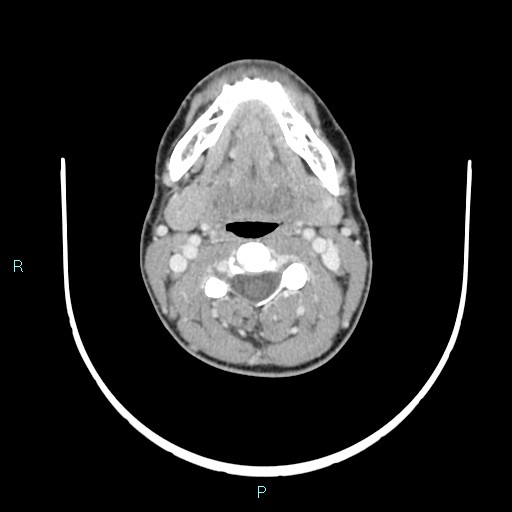 Cervical thymic cyst (Radiopaedia 88632-105335 C 74).jpg