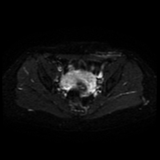 Cesarian section scar endometriosis (Radiopaedia 66520-75799 Axial DWI 12).jpg