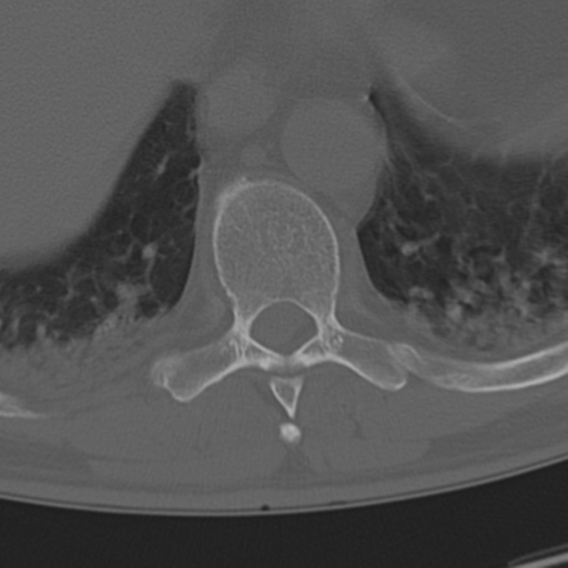 Chance fracture (Radiopaedia 33854-35020 Axial bone window 62).png