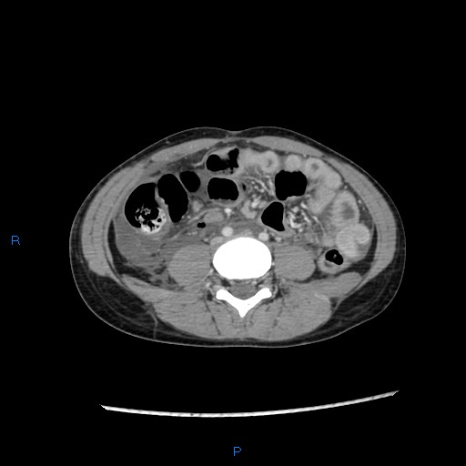 File:Chance fracture with duodenal and pancreatic lacerations (Radiopaedia 43477-46864 A 32).jpg