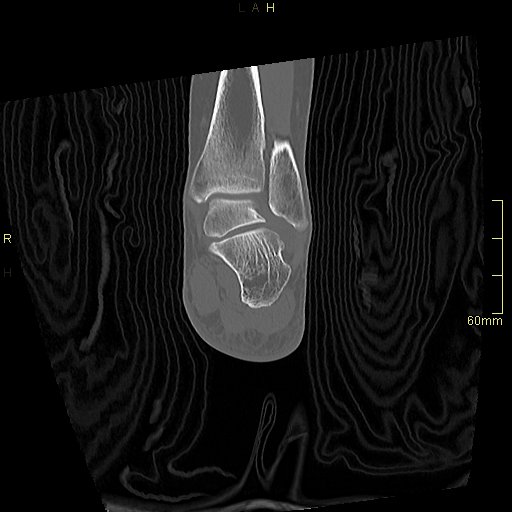 Chaput tubercle fracture (Radiopaedia 80319-93956 Coronal non-contrast 44).jpg