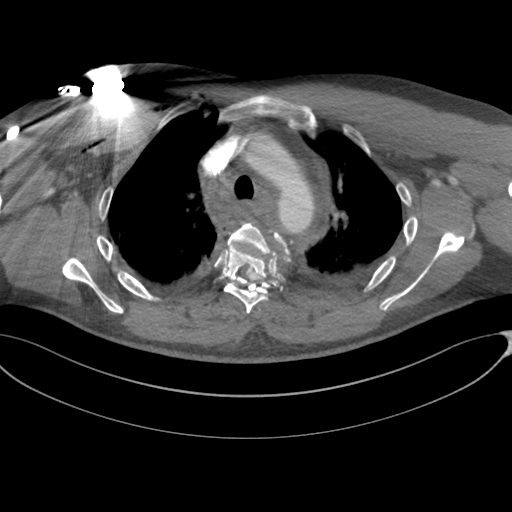 File:Chest multitrauma - aortic injury (Radiopaedia 34708-36147 A 90).png