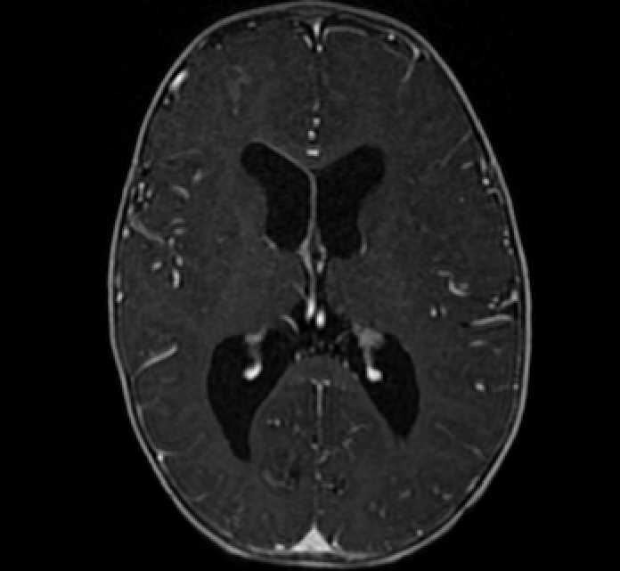 Chiasmatic-hypothalamic glioma (Radiopaedia 90079-107252 Axial T1 C+ 49).jpg