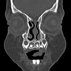File:Choanal atresia (Radiopaedia 88525-105975 Coronal bone window 2).jpg