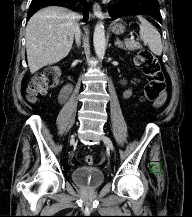 Cholangiocarcinoma with cerebral metastases (Radiopaedia 83519-98629 G 48).jpg