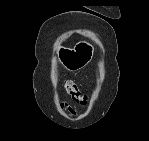 Cholecystoduodenal fistula (Radiopaedia 48959-54022 B 21).jpg