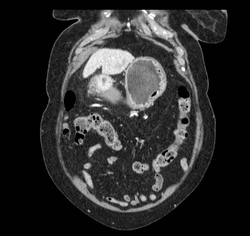 Cholecystoduodenal fistula (Radiopaedia 48959-54022 B 45).jpg