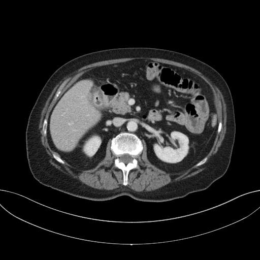 Cholecystoduodenal fistula due to calculous cholecystitis with gallstone migration (Radiopaedia 86875-103077 D 34).jpg
