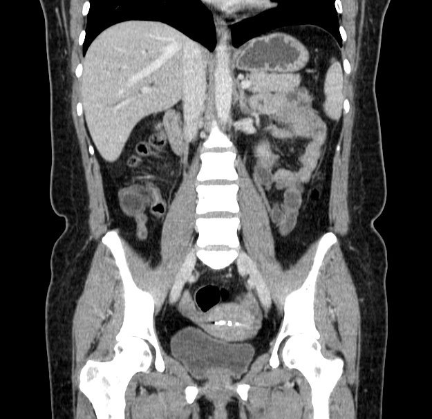Choledocholithiasis on CT and MRI (Radiopaedia 24825-25087 C 28).jpg