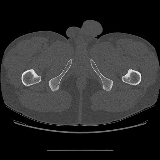 File:Chondrosarcoma of iliac wing (Radiopaedia 63861-72599 Axial bone window 132).jpg
