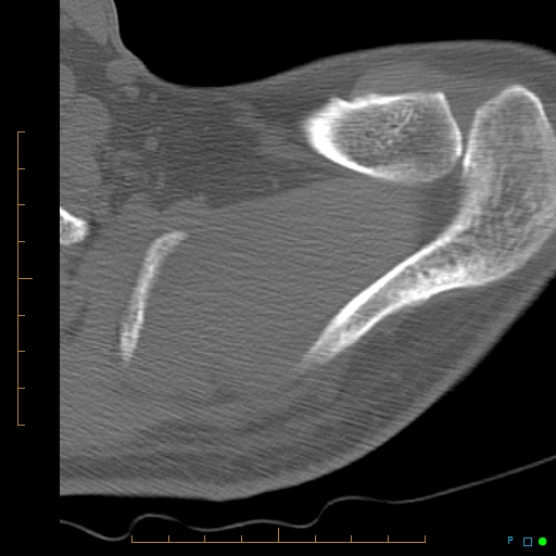 File:Chondrosarcoma of the scapula (Radiopaedia 30696-31399 Axial non-contrast 17).jpg