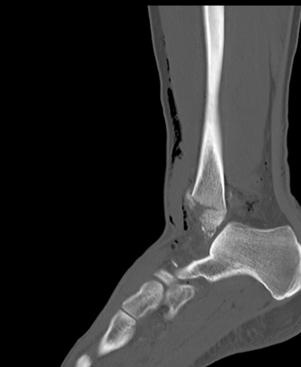 Chopart fracture (Radiopaedia 35347-36851 Sagittal bone window 42).jpg