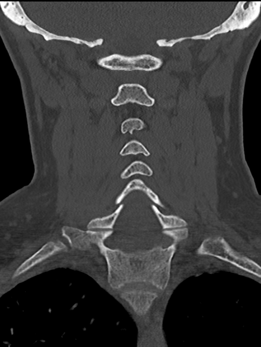 Chordoma (C4 vertebra) (Radiopaedia 47561-52188 Coronal bone window 34).png