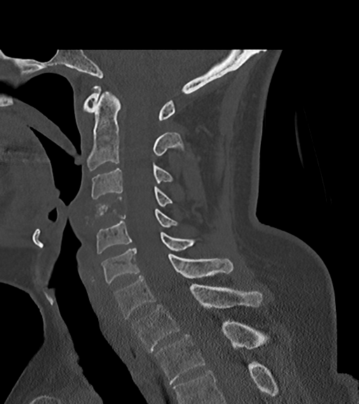 File:Chordoma (C4 vertebra) (Radiopaedia 47561-52188 Sagittal bone window 39).png