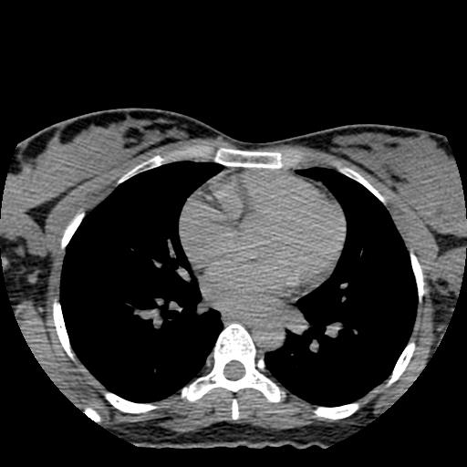 File:Choriocarcinoma of ovary with cerebral and pulmonary metastases (Radiopaedia 25983-26119 Axial non-contrast 146).jpg
