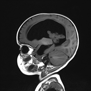 File:Choroid plexus papilloma (Radiopaedia 84612-100019 Sagittal T1 7).jpg