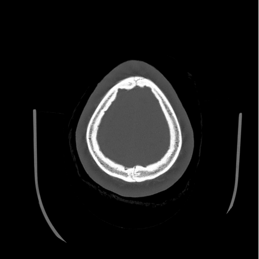 Choroid plexus papilloma extending into the cerebellopontine angle cistern (Radiopaedia 85941-101833 Axial bone window 84).png