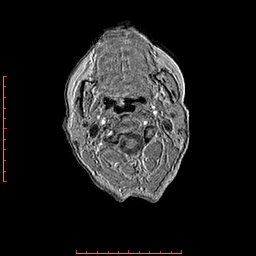 Choroid plexus xanthogranuloma (Radiopaedia 67843-77270 Axial T1 175).jpg