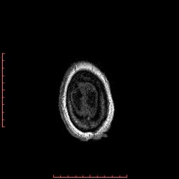Choroid plexus xanthogranuloma (Radiopaedia 67843-77270 Axial T1 19).jpg