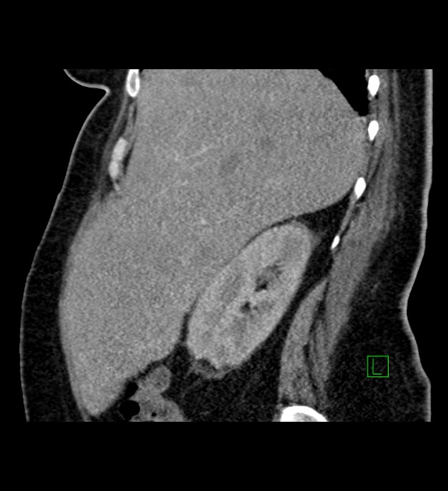 Chromophobe renal cell carcinoma (Radiopaedia 84239-99519 D 87).jpg