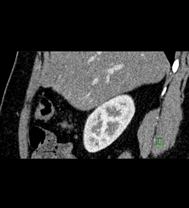 Chromophobe renal cell carcinoma (Radiopaedia 84286-99573 F 130).jpg