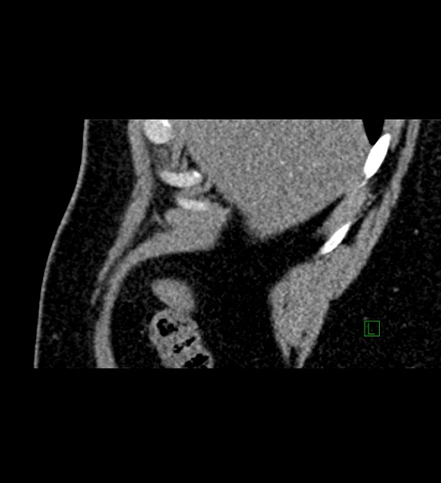 Chromophobe renal cell carcinoma (Radiopaedia 84286-99573 F 162).jpg