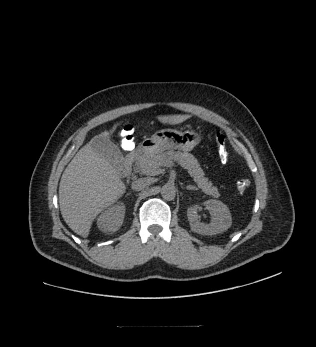 Chromophobe renal cell carcinoma (Radiopaedia 84337-99644 Axial non-contrast 32).jpg