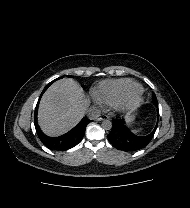 Chromophobe renal cell carcinoma (Radiopaedia 84337-99693 Axial non-contrast 2).jpg