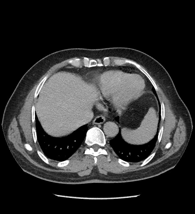 Chromophobe renal cell carcinoma (Radiopaedia 86879-103083 D 9).jpg
