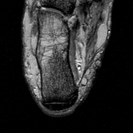 File:Chronic Achilles tendon rupture (Radiopaedia 15262-15100 Axial Gradient Echo 24).jpg