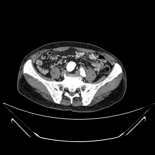 File:Chronic contained rupture of abdominal aortic aneurysm with extensive erosion of the vertebral bodies (Radiopaedia 55450-61901 A 53).jpg