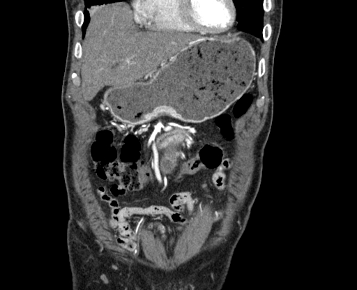 Chronic contained rupture of abdominal aortic aneurysm with extensive erosion of the vertebral bodies (Radiopaedia 55450-61901 D 6).jpg