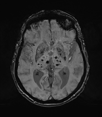 Chronic hypertensive encephalopathy (Radiopaedia 72844-83495 Axial SWI 41).png