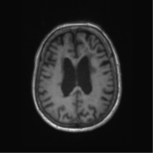 File:Chronic hypertensive encephalopathy (Radiopaedia 72844-83495 Axial T1 26).png