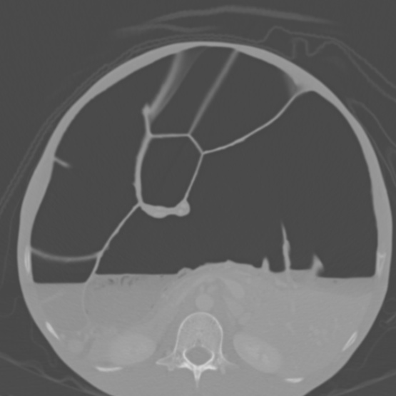Chronic large bowel pseudo-obstruction (Radiopaedia 43181-46492 Axial bone window 78).jpg