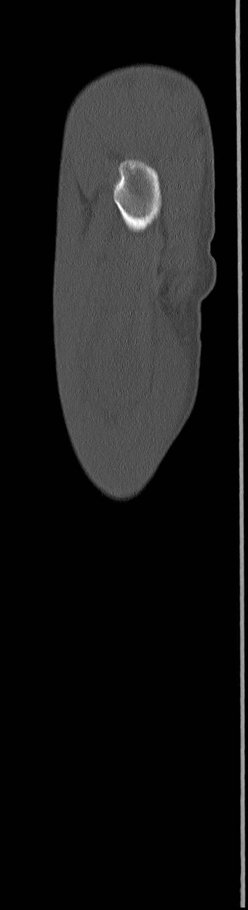 Chronic osteomyelitis (with sequestrum) (Radiopaedia 74813-85822 C 104).jpg