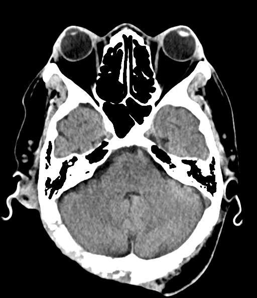 File:Chronic osteomyelitis - calvarial (severe) (Radiopaedia 69668-79616 Axial non-contrast 34).jpg
