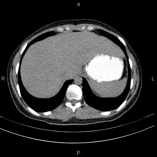 Chronic pancreatitis (Radiopaedia 64576-73450 Axial non-contrast 14).jpg