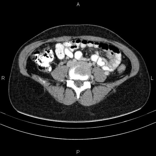 File:Chronic pancreatitis (Radiopaedia 64576-73450 C 108).jpg