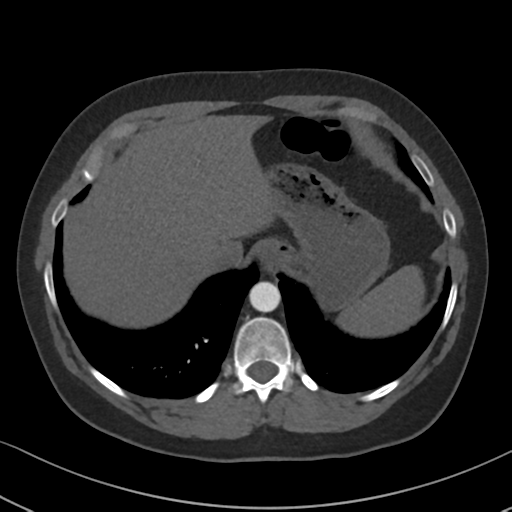 Chronic pulmonary embolus (Radiopaedia 39129-41341 Axial C+ CTPA 87).png
