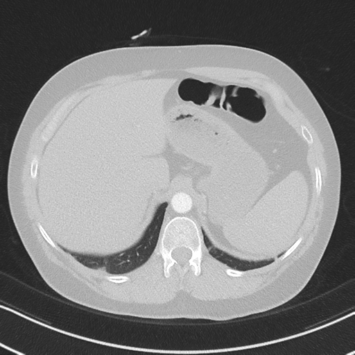 Chronic pulmonary embolus (Radiopaedia 39129-41341 Axial lung window 57).png