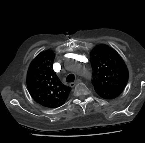 Chronic thromboembolic pulmonary disease (Radiopaedia 90694-108119 Axial C+ CTPA 24).jpg