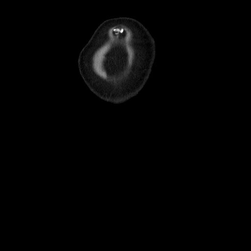 Chyluria following renal ablation (Radiopaedia 81087-94678 C 26).jpg