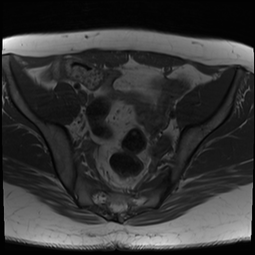 File:Class II Mullerian duct anomaly- unicornuate uterus with rudimentary horn and non-communicating cavity (Radiopaedia 39441-41755 Axial T1 11).jpg