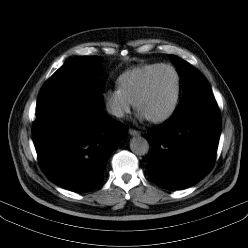 Classic complicated silicosis (Radiopaedia 49720-54961 Axial liver window 39).jpg