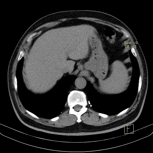 Classic complicated silicosis (Radiopaedia 49720-54961 Axial liver window 50).jpg